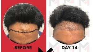 Boostez la Repousse de Vos Cheveux avec le Dermaroller Professionnel
