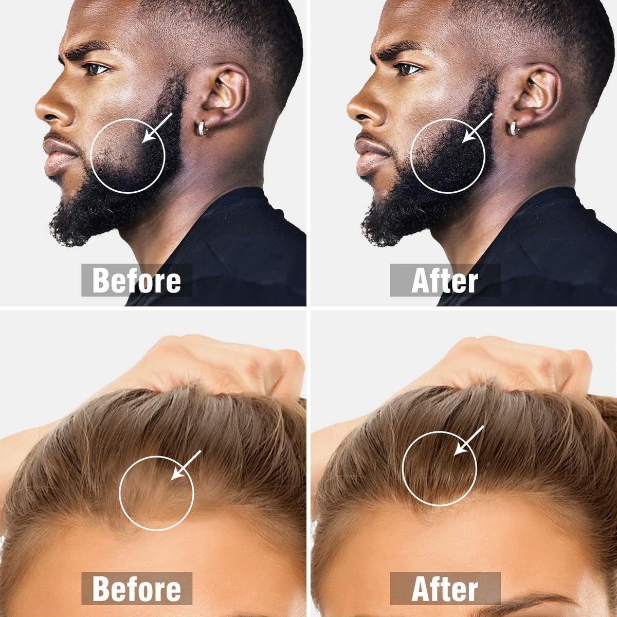 Dermaroller – Dites Adieu à la Perte de Cheveux et aux Trous dans la Barbe