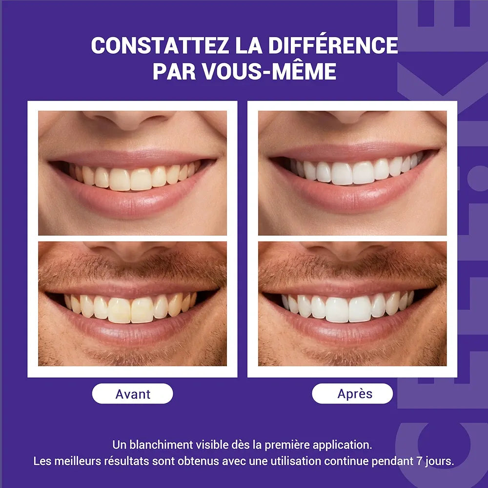 PATCH DENTAIRE SMILKIT Un sourire plus blanc visible en seulement 30 minutes