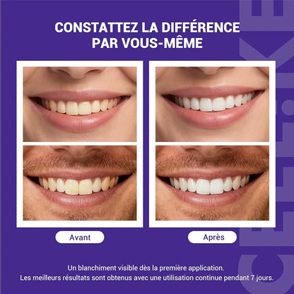 PATCH DENTAIRE SMILKIT Un sourire plus blanc visible en seulement 30 minutes